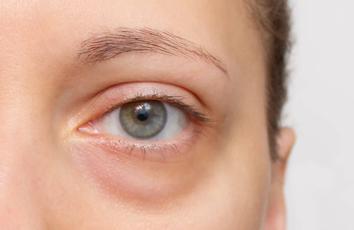 What Causes Gray Eyes? The Science Behind This Rare and Stunning Eye Color